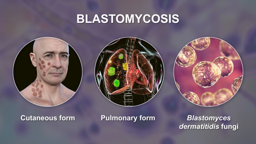 Pulmonale Blastomykose